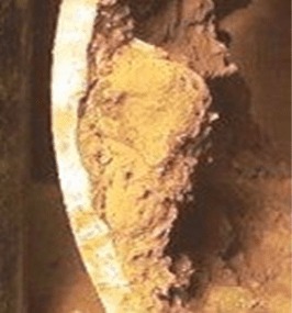 Туберкула — железный оксидный бугор над питтинговой язвой